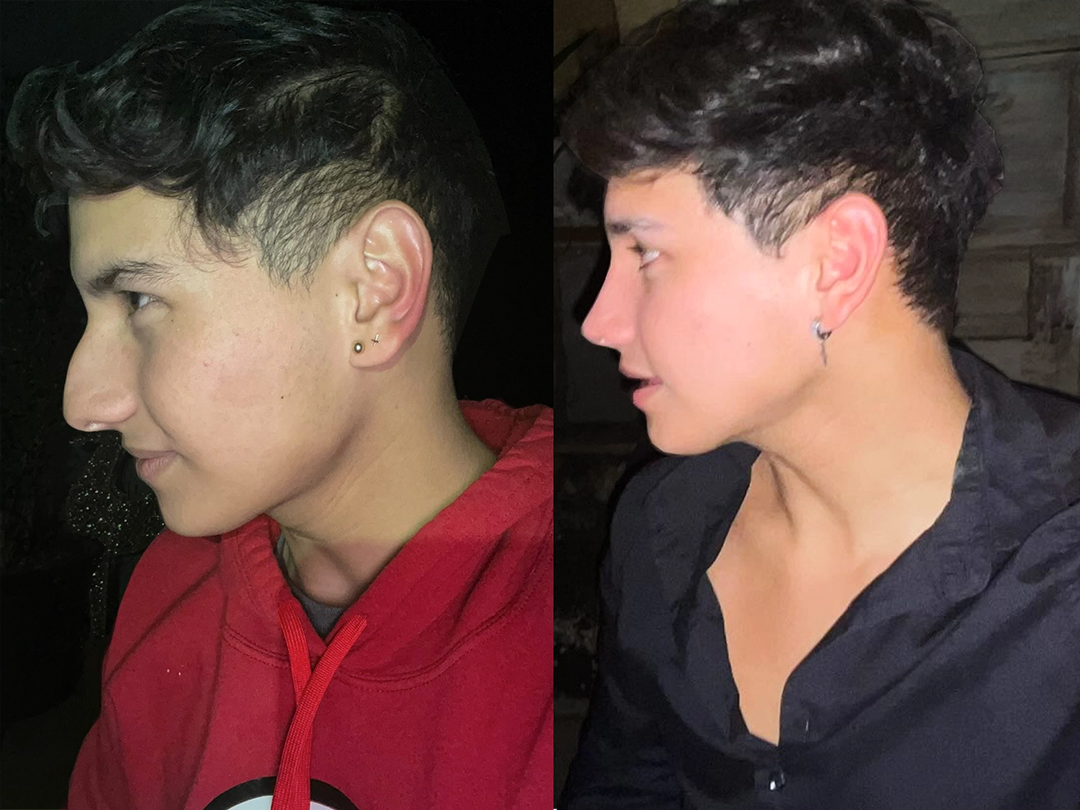 Cambios en la nariz antes y después de la rinoplastia